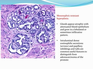Mesonephric remnant
hyperplasia.
• Glands appear atrophic with
attenuated bland epithelium
and grow in a lobulated or
sometimes infiltrative
pattern.
• Intraluminal dense
eosinophilic secretions
(arrows) and papillary
infoldings and tufts are
common useful features to
distinguish from
adenocarcinoma of the
prostate
 