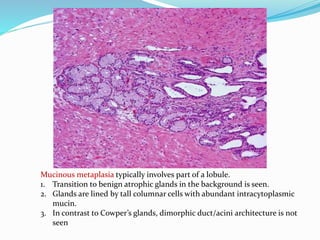 Mucinous metaplasia typically involves part of a lobule.
1. Transition to benign atrophic glands in the background is seen.
2. Glands are lined by tall columnar cells with abundant intracytoplasmic
mucin.
3. In contrast to Cowper’s glands, dimorphic duct/acini architecture is not
seen
 