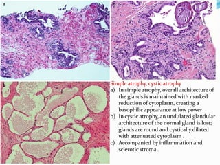 Simple atrophy, cystic atrophy
a) In simple atrophy, overall architecture of
the glands is maintained with marked
reduction of cytoplasm, creating a
basophilic appearance at low power
b) In cystic atrophy, an undulated glandular
architecture of the normal gland is lost;
glands are round and cystically dilated
with attenuated cytoplasm .
c) Accompanied by inflammation and
sclerotic stroma .
 