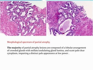 Morphological spectrum of partial atrophy.
The majority of partial atrophy lesions are composed of a lobular arrangement
of crowded glands with stellate/undulating gland lumina, and scant pale clear
cytoplasm, imparting a distinct pale appearance at low power .
 