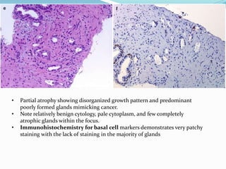 • Partial atrophy showing disorganized growth pattern and predominant
poorly formed glands mimicking cancer.
• Note relatively benign cytology, pale cytoplasm, and few completely
atrophic glands within the focus.
• Immunohistochemistry for basal cell markers demonstrates very patchy
staining with the lack of staining in the majority of glands
 