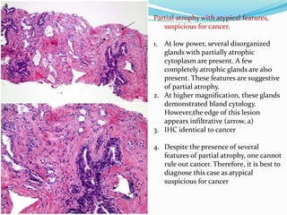 Partial atrophy with atypical features,
suspicious for cancer.
1. At low power, several disorganized
glands with partially atrophic
cytoplasm are present. A few
completely atrophic glands are also
present. These features are suggestive
of partial atrophy.
2. At higher magnification, these glands
demonstrated bland cytology.
However,the edge of this lesion
appears infiltrative (arrow, a)
3. IHC identical to cancer
4. Despite the presence of several
features of partial atrophy, one cannot
rule out cancer. Therefore, it is best to
diagnose this case as atypical
suspicious for cancer
 