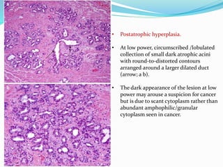 • Postatrophic hyperplasia.
• At low power, circumscribed /lobulated
collection of small dark atrophic acini
with round-to-distorted contours
arranged around a larger dilated duct
(arrow; a b).
• The dark appearance of the lesion at low
power may arouse a suspicion for cancer
but is due to scant cytoplasm rather than
abundant amphophilic/granular
cytoplasm seen in cancer.
 