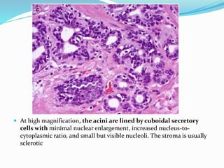  At high magnification, the acini are lined by cuboidal secretory
cells with minimal nuclear enlargement, increased nucleus-to-
cytoplasmic ratio, and small but visible nucleoli. The stroma is usually
sclerotic
 