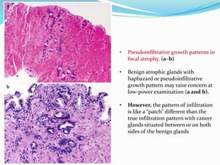 • Pseudoinfiltrative growth patterns in
focal atrophy. (a–b)
• Benign atrophic glands with
haphazard or pseudoinfiltrative
growth pattern may raise concern at
low-power examination (a and b).
• However, the pattern of infiltration
is like a “patch” different than the
true infiltration pattern with cancer
glands situated between or on both
sides of the benign glands
 