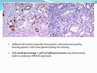 • (e)Basal cell markers typically demonstrate a discontinuous/patchy-
staining pattern, with some glands lacking the staining .
• (f)A small percentage (~30%) of adenosis lesions may demonstrate
mild-to-moderate AMACR expression
 