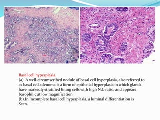 Basal cell hyperplasia.
(a). A well-circumscribed nodule of basal cell hyperplasia, also referred to
as basal cell adenoma is a form of epithelial hyperplasia in which glands
have markedly stratified lining cells with high N:C ratio, and appears
basophilic at low magnification
(b).In incomplete basal cell hyperplasia, a luminal differentiation is
Seen.
 