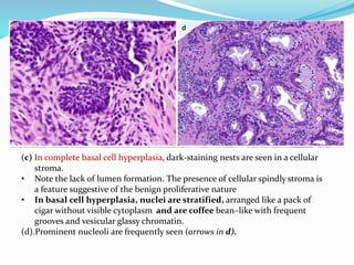 (c) In complete basal cell hyperplasia, dark-staining nests are seen in a cellular
stroma.
• Note the lack of lumen formation. The presence of cellular spindly stroma is
a feature suggestive of the benign proliferative nature
• In basal cell hyperplasia, nuclei are stratified, arranged like a pack of
cigar without visible cytoplasm and are coffee bean–like with frequent
grooves and vesicular glassy chromatin.
(d).Prominent nucleoli are frequently seen (arrows in d).
 