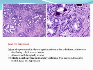 Basal cell hyperplasia
(e)can also present with adenoid cystic carcinoma-like cribriform architecture
simulating cribriform carcinoma.
• Also note cellular spindly stroma
(f)Intraluminal calcifications and cytoplasmic hyaline globules can be
seen in basal cell hyperplasia
 