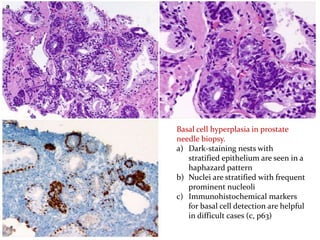 Basal cell hyperplasia in prostate
needle biopsy.
a) Dark-staining nests with
stratified epithelium are seen in a
haphazard pattern
b) Nuclei are stratified with frequent
prominent nucleoli
c) Immunohistochemical markers
for basal cell detection are helpful
in difficult cases (c, p63)
 