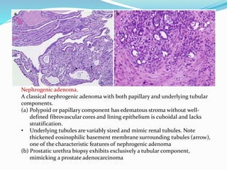 Nephrogenic adenoma.
A classical nephrogenic adenoma with both papillary and underlying tubular
components.
(a) Polypoid or papillary component has edematous stroma without well-
defined fibrovascular cores and lining epithelium is cuboidal and lacks
stratification.
• Underlying tubules are variably sized and mimic renal tubules. Note
thickened eosinophilic basement membrane surrounding tubules (arrow),
one of the characteristic features of nephrogenic adenoma
(b) Prostatic urethra biopsy exhibits exclusively a tubular component,
mimicking a prostate adenocarcinoma
 