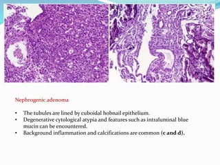 Nephrogenic adenoma
• The tubules are lined by cuboidal hobnail epithelium.
• Degenerative cytological atypia and features such as intraluminal blue
mucin can be encountered.
• Background inflammation and calcifications are common (c and d).
 
