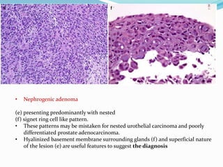 • Nephrogenic adenoma
(e) presenting predominantly with nested
(f) signet ring cell like pattern.
• These patterns may be mistaken for nested urothelial carcinoma and poorly
differentiated prostate adenocarcinoma.
• Hyalinized basement membrane surrounding glands (f) and superficial nature
of the lesion (e) are useful features to suggest the diagnosis
 