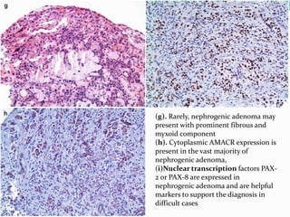 (g). Rarely, nephrogenic adenoma may
present with prominent fibrous and
myxoid component
(h). Cytoplasmic AMACR expression is
present in the vast majority of
nephrogenic adenoma,
(i)Nuclear transcription factors PAX-
2 or PAX-8 are expressed in
nephrogenic adenoma and are helpful
markers to support the diagnosis in
difficult cases
 