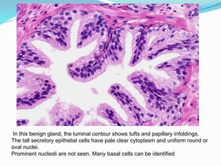 In this benign gland, the luminal contour shows tufts and papillary infoldings.
The tall secretory epithelial cells have pale clear cytoplasm and uniform round or
oval nuclei.
Prominent nucleoli are not seen. Many basal cells can be identified
 