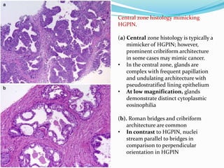 Central zone histology mimicking
HGPIN.
(a) Central zone histology is typically a
mimicker of HGPIN; however,
prominent cribriform architecture
in some cases may mimic cancer.
• In the central zone, glands are
complex with frequent papillation
and undulating architecture with
pseudostratified lining epithelium
• At low magnification, glands
demonstrate distinct cytoplasmic
eosinophilia
(b). Roman bridges and cribriform
architecture are common
• In contrast to HGPIN, nuclei
stream parallel to bridges in
comparison to perpendicular
orientation in HGPIN
 