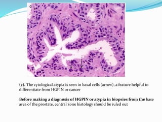 (c). The cytological atypia is seen in basal cells (arrow), a feature helpful to
differentiate from HGPIN or cancer
Before making a diagnosis of HGPIN or atypia in biopsies from the base
area of the prostate, central zone histology should be ruled out
 