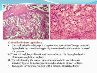 Clear cell cribriform hyperplasia.
• Clear cell cribriform hyperplasia represents a spectrum of benign prostate
hyperplasia and therefore is typically encountered in the transition zone of
the prostate.
(a)There is a nodular proliferation of nonconfluent cribriform glands with
clear to eosinophilic cytoplasm
(b)The cells forming the central lumina are cuboidal to low columnar
secretory-type cells, with uniform round nuclei and clear cytoplasm.
• The glands (arrows) are rimmed with a prominent basal cell layer
 
