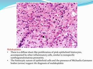Malakoplakia.
• There is a diffuse sheet-like proliferation of pink epithelioid histiocytes,
accompanied by other inflammatory cells, similar to nonspecific
xanthogranulomatous prostatitis.
• The histiocytic nature of epithelioid cells and the presence of Michaelis-Gutmann
bodies (arrow) suggest the diagnosis of malakoplakia
 