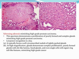 Sclerosing adenosis mimicking high-grade prostate carcinoma.
• This specimen demonstrates a proliferation of poorly formed and complex glands
mimicking high-grade prostate carcinoma.
• Lowpower recognition is a key.
(a). It typically forms a well-circumscribed nodule of tightly packed glands
(b). At high magnification, glands demonstrate complex proliferation, poorly formed
glands with slit-like lumina, fused glands, and even single cells with signet ring
cell-like features, mimicking high-grade cancer
 