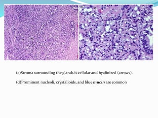 (c)Stroma surrounding the glands is cellular and hyalinized (arrows).
(d)Prominent nucleoli, crystalloids, and blue mucin are common
 