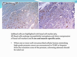(e)Basal cells are highlighted with basal cell marker p63.
(f) Basal cells undergo myoepithelial metaplasia and show coexpression
of basal cell markers and S-100 and muscle-specific actin.
• When one or more well-circumscribed cellular lesions mimicking
high-grade prostate cancer are encountered in TURP or biopsies
from the transition zone of the prostate, sclerosing adenosis should
be ruled out
 