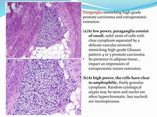 Paraganglia mimicking high-grade
prostate carcinoma and extraprostatic
extension.
(a)At low power, paraganglia consist
of small, solid nests of cells with
clear cytoplasm separated by a
delicate vascular network,
mimicking high-grade Gleason
pattern 4 or 5 prostate carcinoma.
• Its presence in adipose tissue ,
impart an impression of
extraprostatic tumor extension.
(b)At high power, the cells have clear
to amphophilic, finely granular
cytoplasm. Random cytological
atypia may be seen and nuclei are
often hyperchromatic, but nucleoli
are inconspicuous.
 