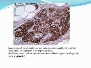 Recognition of the delicate vascular network pattern referred to as the
“Zellballen” arrangement is an important clue.
In difficult cases, positive neuroendocrine markers support the diagnosis
(synaptophysin)
 
