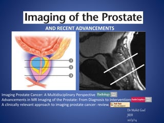 Dr Mohit Goel
JRIII
20/9/14
AND RECENT ADVANCEMENTS
Imaging Prostate Cancer: A Multidisciplinary Perspective
Advancements in MR Imaging of the Prostate: From Diagnosis to Interventions
A clinically relevant approach to imaging prostate cancer: review.
 