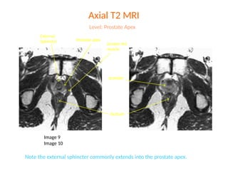 prostate ca 3.pptx radiation oncology pdf | PPTX