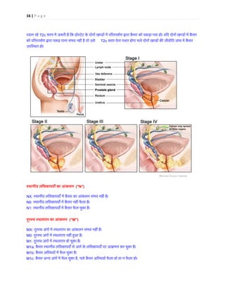16 | P a g e
ध्यान रहेT2c चरण में ज�री है िक प्रोस्टेट के दोनों खण्डों में प�रस्पशर्ण द्वारा कैंसर को पकड़ा गया हो। यिद दोनों
को प�रस्पशर्ण द्वारा पकड़ पाना संभव नहीं है तो T2c चरण देना गलत होगा भले दोनों खण्डों क� जीवोितजांच में क
उपिस्थत हो। 
स्थानीय लिसकापव� का आंकलन ("N")
NX: स्थानीय लिसकापव� में कैंसर का आंकलन संभव नहीं है
N0: स्थानीय लिसकापव� में कैंसर नहीं फैला ह
N1: स्थानीय लिसकापव� में कैंसर फैल चुका है
दूरस्थ स्थलांतर का आंकलन("M")
MX: दूरस्थ अंगों में स्थलांतर का आंकलन संभव नहीं ह
M0: दूरस्थ अंगों में स्थलांतर नहीं ह�आ ह
M1: दूरस्थ अंगों में स्थलांतर हो चुका है
M1a: कैंसर स्थानीय लिसकापव� से आगे के लिसकापव� पर आक्रमण कर चुका है
M1b: कैंसर अिस्थयों में फैल चुका ह
M1c: कैंसर अन्यअंगों में फैल चुक, भले कैंसर अिस्थयों फैला हो या न फैला हो।
 
