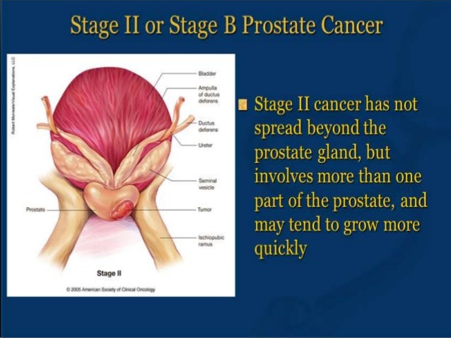 Prostate cancer for public awareness by DR RUBZ