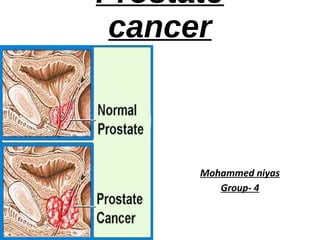 Prostate
cancer
Mohammed niyas
Group- 4
 