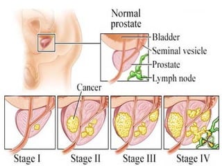 Prostate cancer