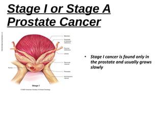Prostate cancer