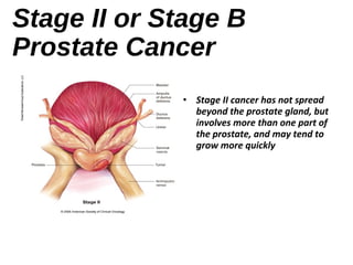 Prostate cancer