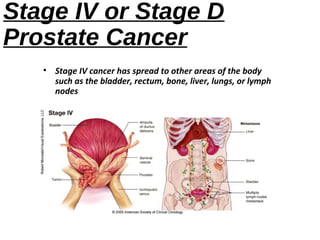 Prostate cancer