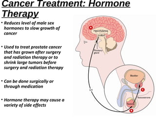 Prostate cancer