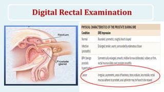 High Riding Prostate Sign Prostate cancer | PPTX