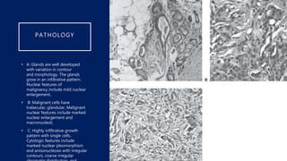 Prostate Cancer (Urology) | PPTX
