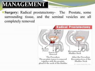 MANAGEMENT
Prostate, some
vesicles are all
⚫Surgery: Radical prostatectomy- The
surrounding tissue, and the seminal
completely removed
 