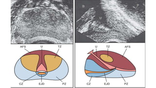 THE MANAGEMENT OF PROSTATE CANCER . pptx | PPTX
