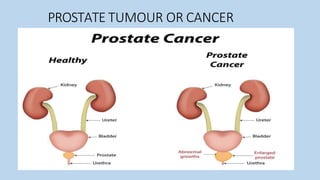 PROSTATE TUMOUR OR CANCER
 