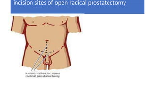 incision sites of open radical prostatectomy
 
