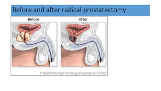 Before and after radical prostatectomy
 