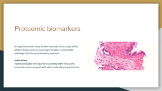 Proteomic biomarkers
An eight-biomarker assay further improves the accuracy of the
Gleason biopsy score in assessing favorable or unfavorable
pathology from the prostatectomy specimen.
Implications
Additional studies are required to understand the role of this
proteomic assay compared with other molecular prognostic tests.
 
