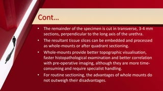 Cont…
• The remainder of the specimen is cut in transverse, 3-4 mm
sections, perpendicular to the long axis of the urethra.
• The resultant tissue slices can be embedded and processed
as whole-mounts or after quadrant sectioning.
• Whole-mounts provide better topographic visualisation,
faster histopathological examination and better correlation
with pre-operative imaging, although they are more time-
consuming and require specialist handling.
• For routine sectioning, the advantages of whole mounts do
not outweigh their disadvantages.
 