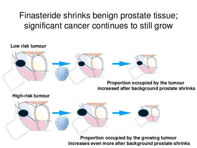 Use prostate finasteride cancer in