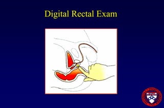 Prostate Cancer Overview