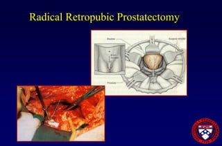 Prostate Cancer Overview